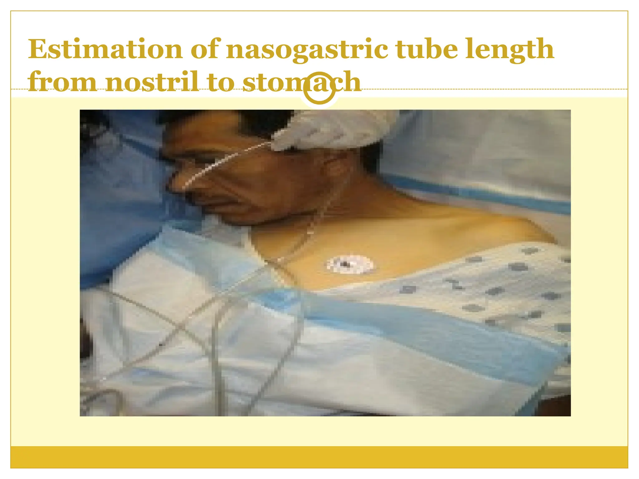 Estimation of nasogastric tube length
from nostril to stomach
 