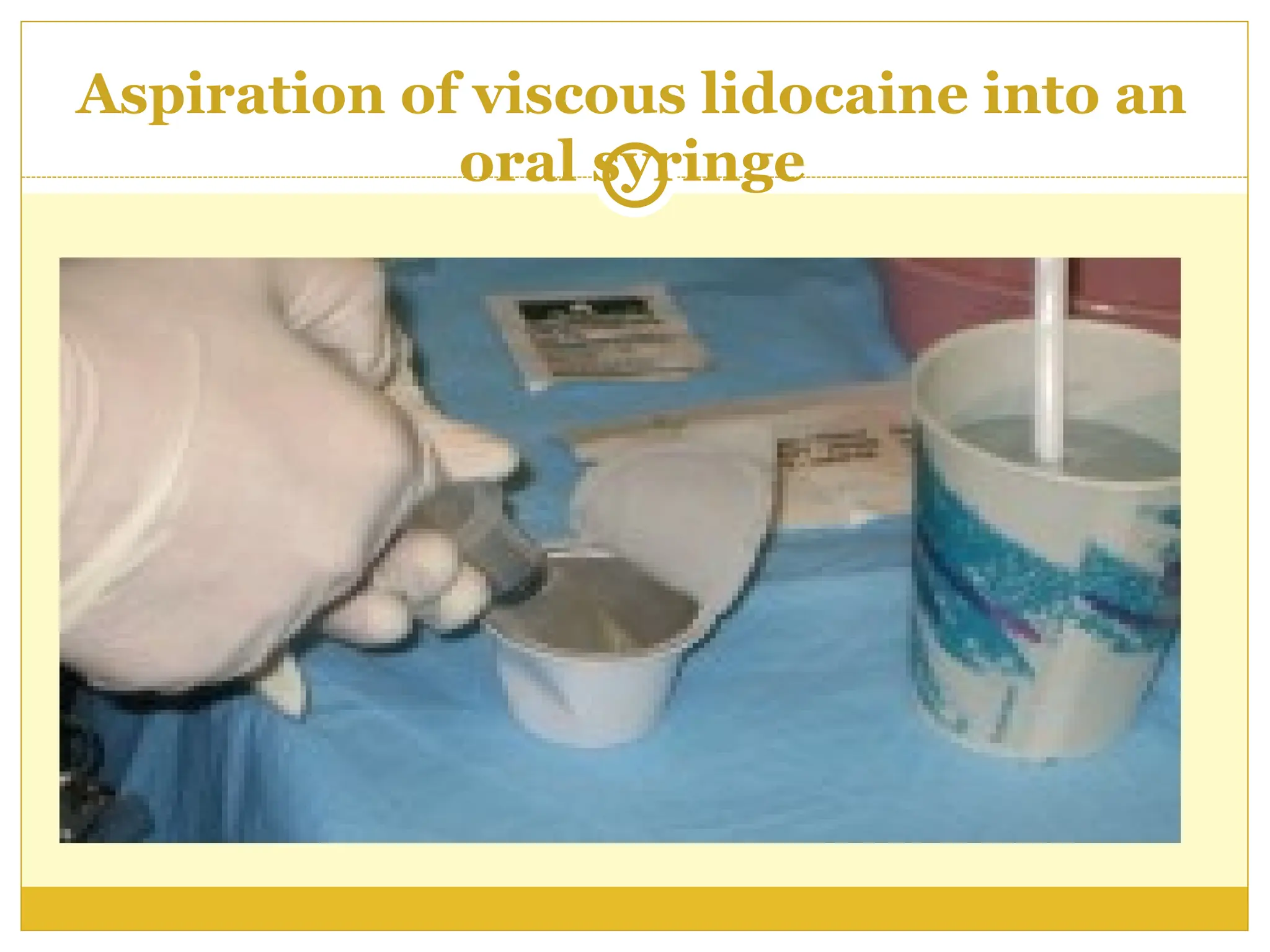 Aspiration of viscous lidocaine into an
oral syringe
 
