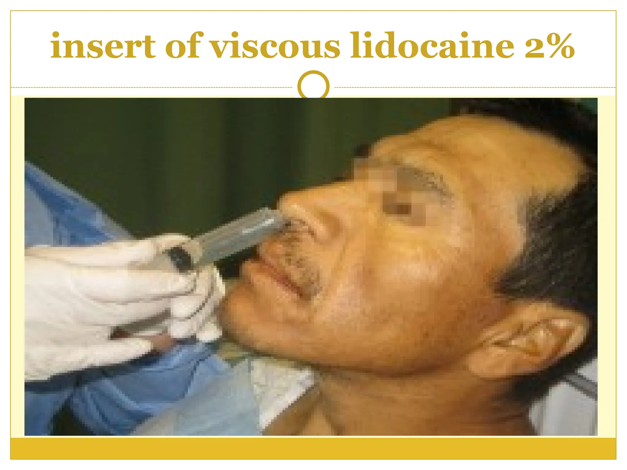 insert of viscous lidocaine 2%
 