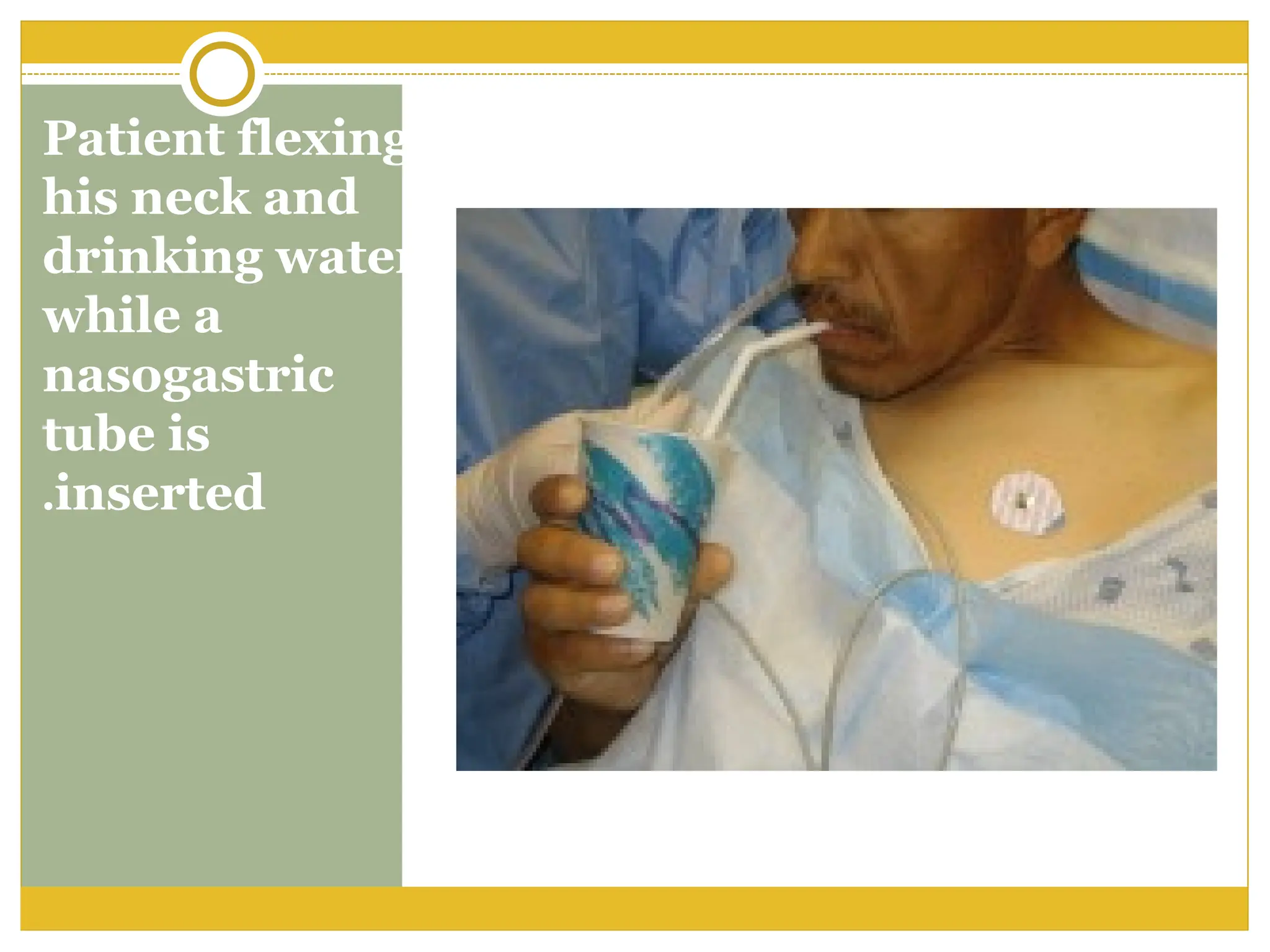 Patient flexing
his neck and
drinking water
while a
nasogastric
tube is
inserted
.
 