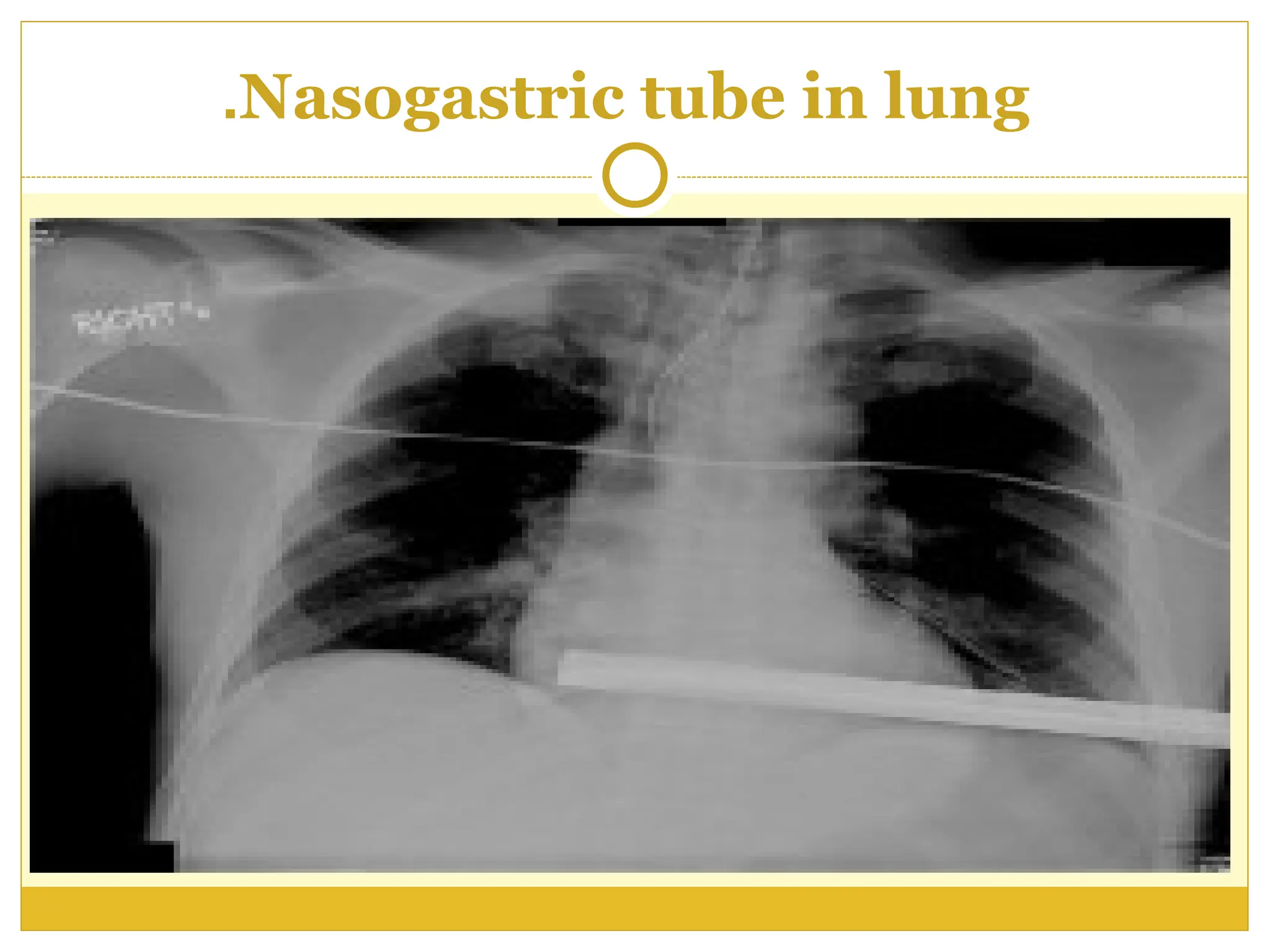 Nasogastric tube in lung
.
 