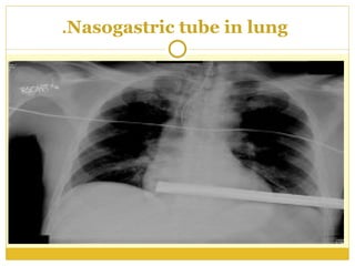 259153869-Procedure-of-Inserting-nasogastric-tube-ppt.ppt