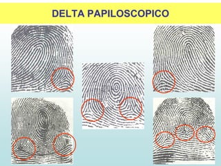 DELTA PAPILOSCOPICO
 