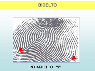 BIDELTO
INTRADELTO “i”
 