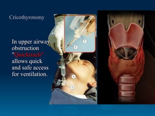 Quicktrach Inuse BLS,ACLS & ATLS- Need – cardiac arrest &Trauma remains the leading ...