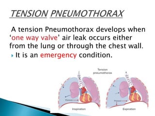 Tension pneumothorax | PPT
