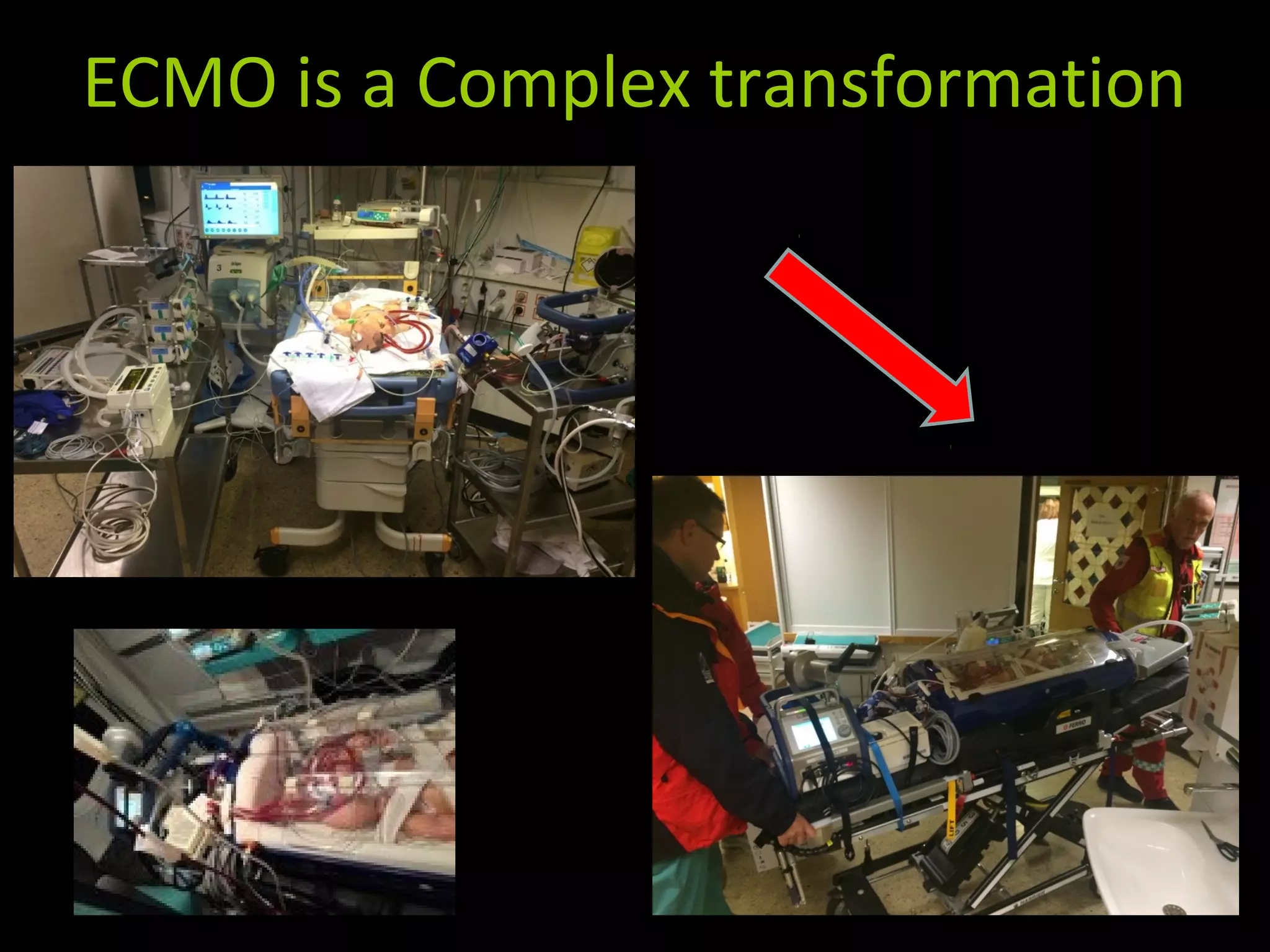 ECMO is a Complex transformation
 