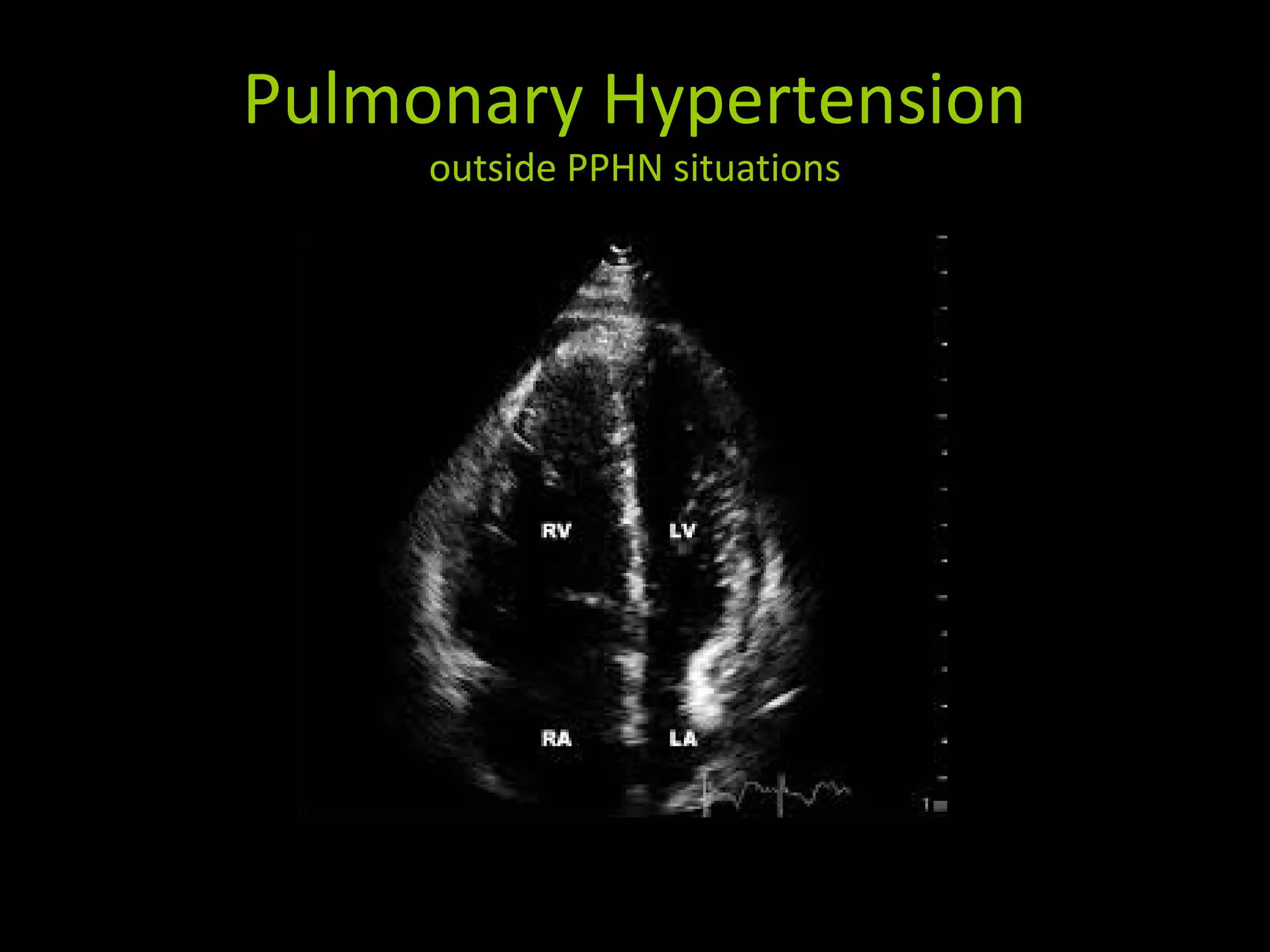 Pulmonary Hypertension
outside PPHN situations
 