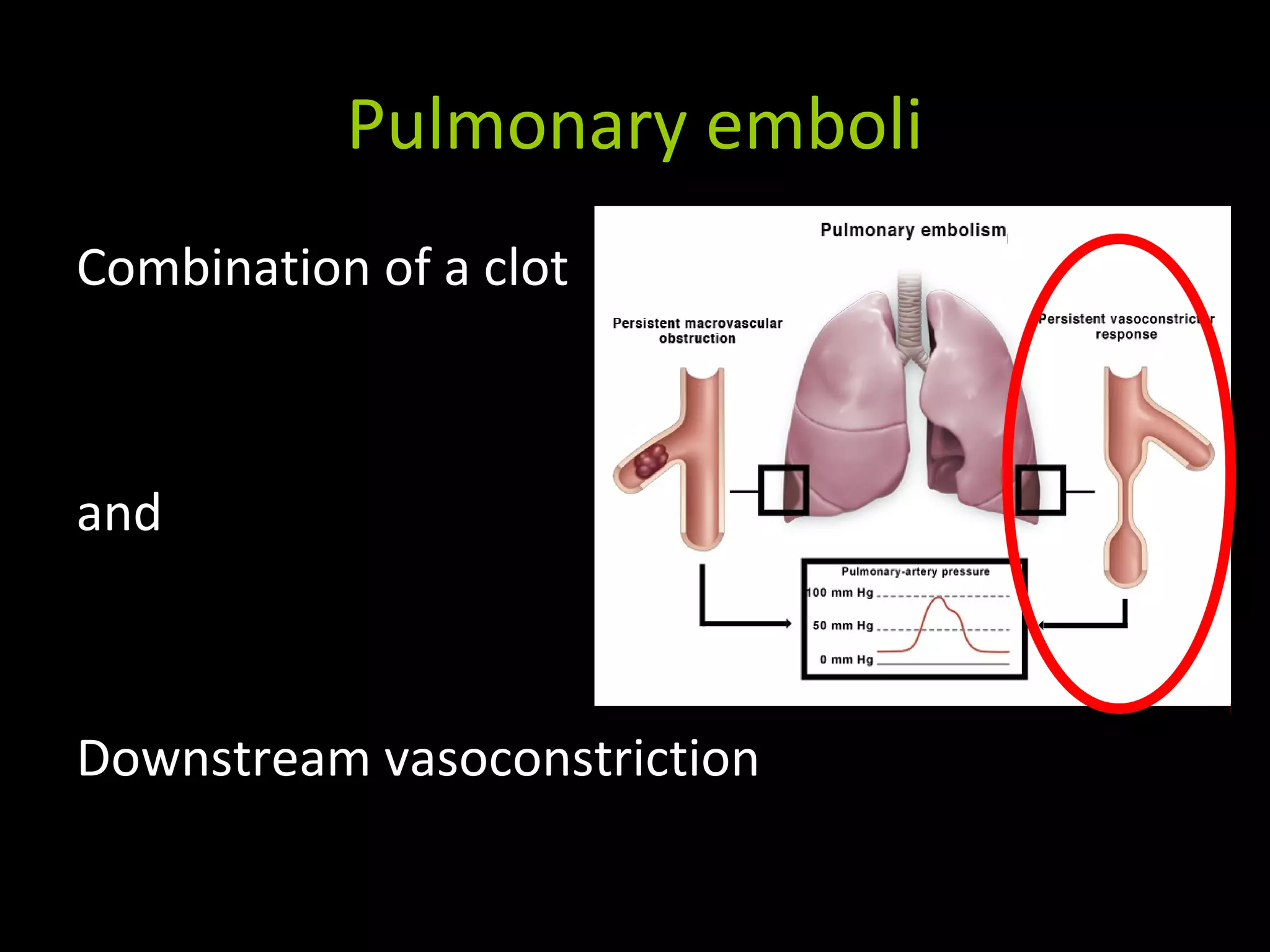 Pulmonary emboli
Combination of a clot
and
Downstream vasoconstriction
 