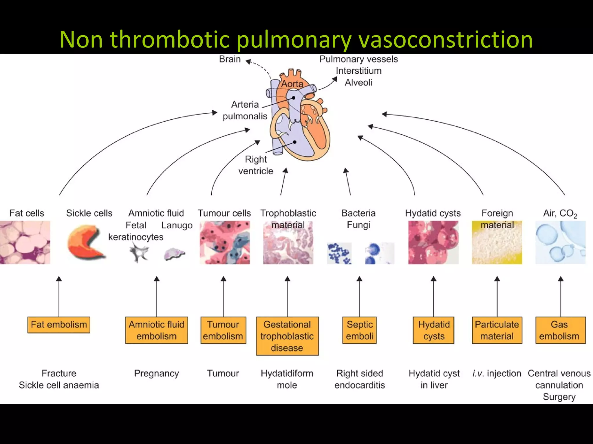 Non thrombotic pulmonary vasoconstriction
 
