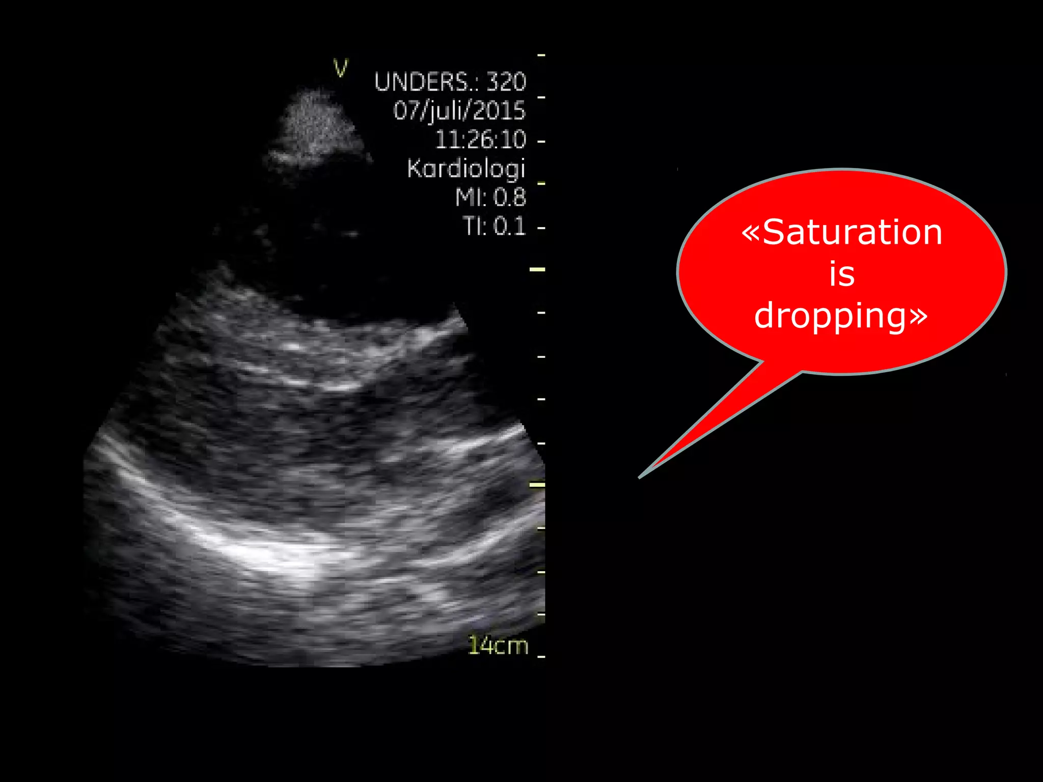 «Saturation
is
dropping»
 