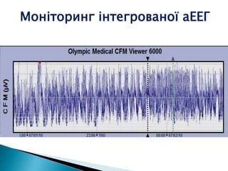 Моніторинг інтегрованої аЕЕГ
 