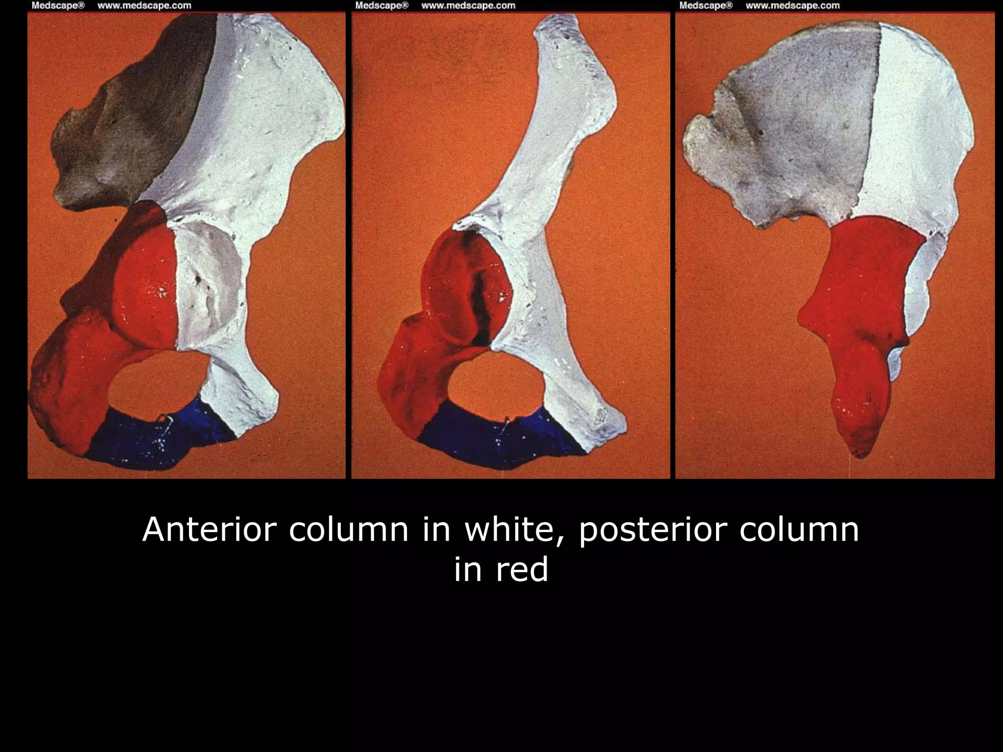 26. acetabular fractures anatomy, evaluation and classification ...