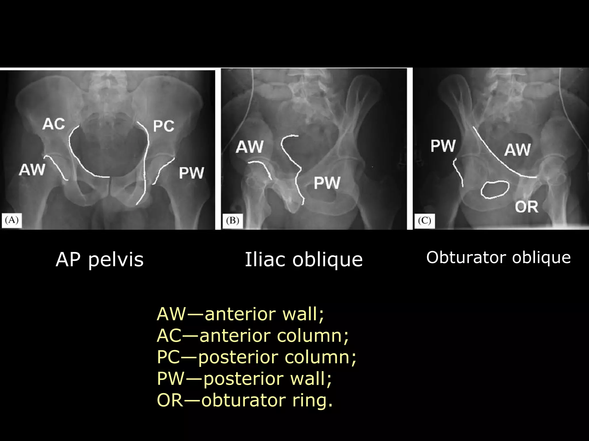26. acetabular fractures anatomy, evaluation and classification ...