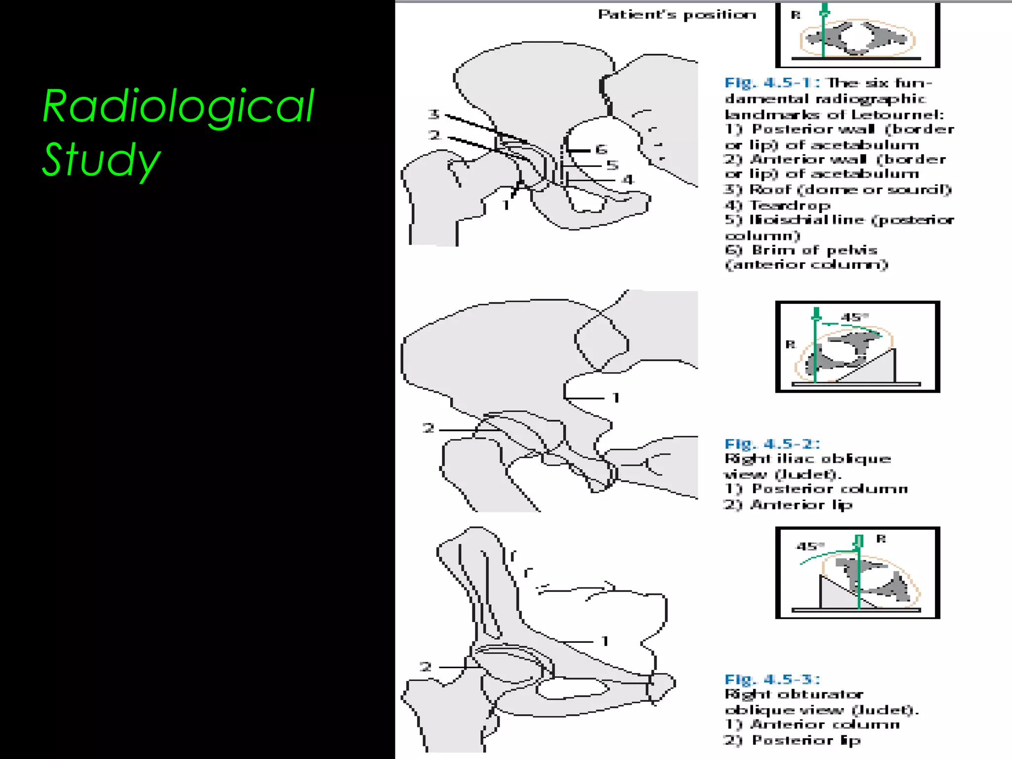 26. acetabular fractures anatomy, evaluation and classification ...