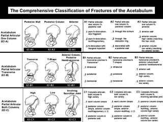 26. acetabular fractures anatomy, evaluation and classification ...