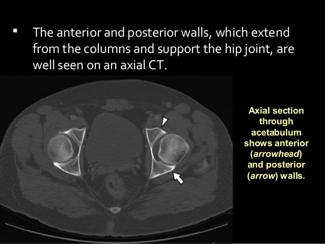 26. acetabular fractures anatomy, evaluation and classification
