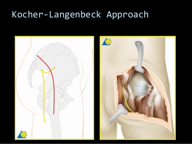 26 acetabular fractures treatment muhammad abdelghani 19 638