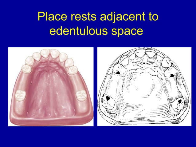 26. designing of rpd | PPT | Dental Health | Diseases and Conditions