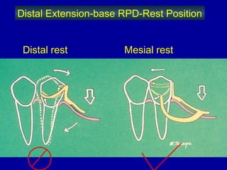 26. designing of rpd | PPT
