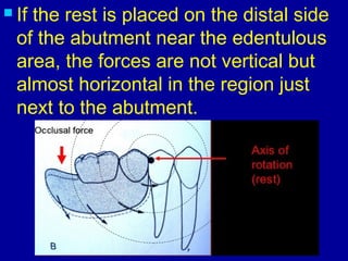 Inverted Rest Rpd 26. designing of rpd | PPT