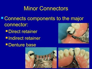 Rest Connector Rpd 26. designing of rpd | PPT