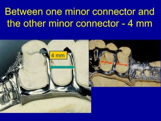 Minor Connector Rpd Design 26. designing of rpd | PPT