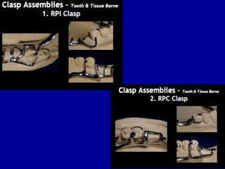 26. designing of rpd | PPT