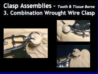 Wrought Wire Design Rpd 26. designing of rpd | PPT