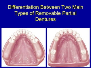 The Dual Path Rpd 26. designing of rpd | PPT