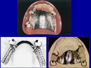Rpd Rope Link 26. designing of rpd | PPT