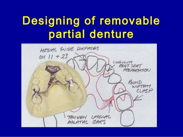 removable partial denture design