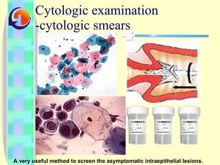 Cytologic examination -cytologic smears A very useful method to screen the asymptomatic intraepithelial lesions.   