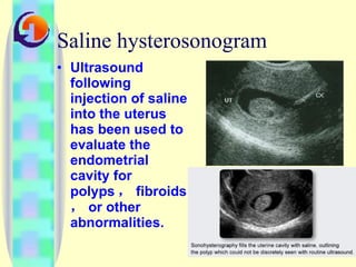 Saline hysterosonogram Ultrasound following injection of saline into the uterus has been used to evaluate the endometrial cavity for polyps ， fibroids ， or other abnormalities. 