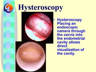 Hysteroscopy Hysteroscopy Placing an endoscopic camera through the cervix into the endometrial cavity allows direct visualization of the cavity.  
