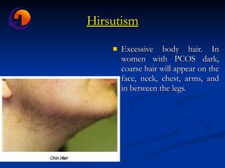 Hirsutism Excessive body hair. In women with PCOS dark, coarse hair will appear on the face, neck, chest, arms, and in between the legs. 