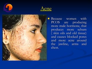 Acne Because women with PCOS are producing more male hormone, that produces more sebum ( skin oils and old tissue) and causes blocked pores and more acne around the jawline, arms and chest.   