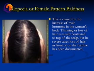 Alopecia or Female Pattern Baldness This is caused by the increase of male hormone in the women's body. Thinning or loss of hair is usually contained to top of the scalp, but in severe cases loss of hair in front or on the hairline has been documented. 