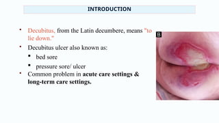 Comprehensive Guide to Decubitus Ulcers: Causes, Stages, and Prevention ...