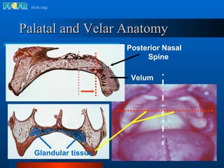 Palatal and Velar Anatomy Posterior Nasal Spine Velum Glandular tissue 