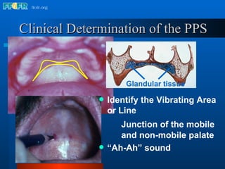 Clinical Determination of the PPS Identify the Vibrating Area or Line Junction of the mobile  and non-mobile palate “ Ah-Ah” sound Glandular tissue 