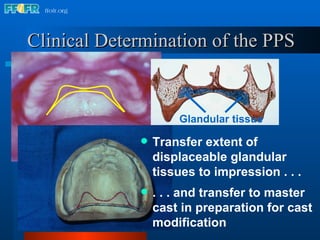 Clinical Determination of the PPS Transfer extent of displaceable glandular tissues to impression . . . Glandular tissue . . . and transfer to master cast in preparation for cast modification 
