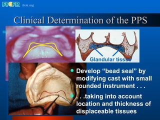 Clinical Determination of the PPS Develop “bead seal” by modifying cast with small rounded instrument . . . Glandular tissue . . .taking into account location and thickness of displaceable tissues 
