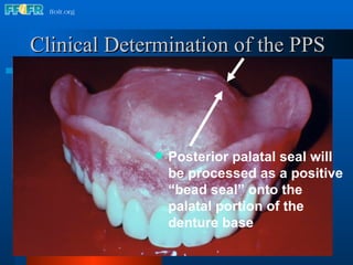Clinical Determination of the PPS Posterior palatal seal will be processed as a positive “bead seal” onto the palatal portion of the denture base Glandular tissue 