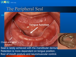 The Peripheral Seal Tongue function Cheek and labial function Seal is rarely achieved with the mandibular denture.  Retention is more dependent on tongue position, floor of mouth posture and neuromuscular control. 