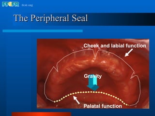 The Peripheral Seal Cheek and labial function Palatal function Gravity 