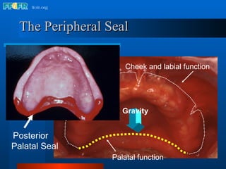 The Peripheral Seal Cheek and labial function Palatal function Gravity Posterior Palatal Seal 
