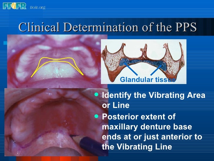posterior palatal seal
