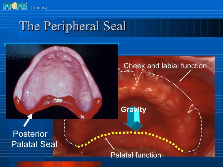 26.posterior palatal seal