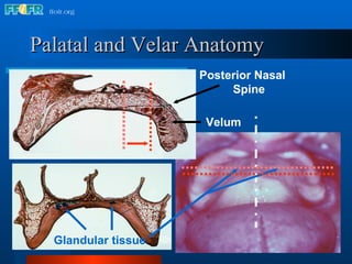 Palatal and Velar Anatomy Posterior Nasal Spine Glandular tissue Velum 